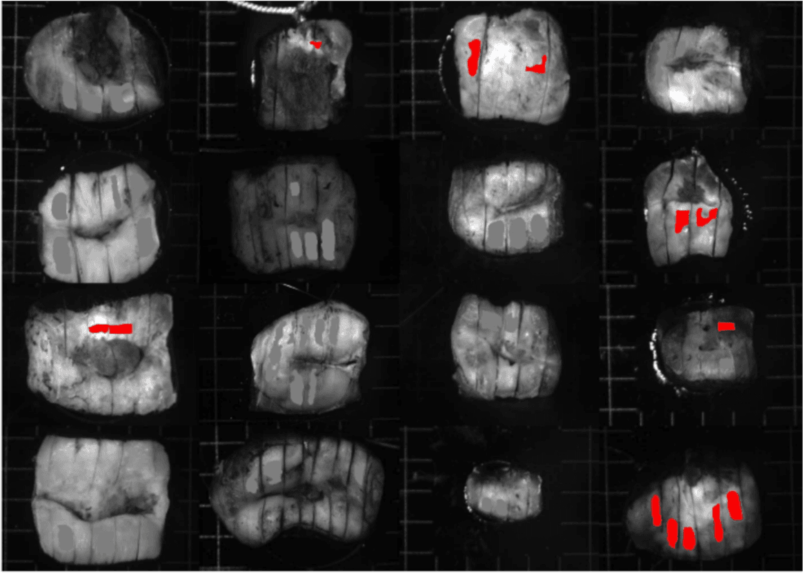 Détection Précoce des Pathologies du Col de l'Utérus